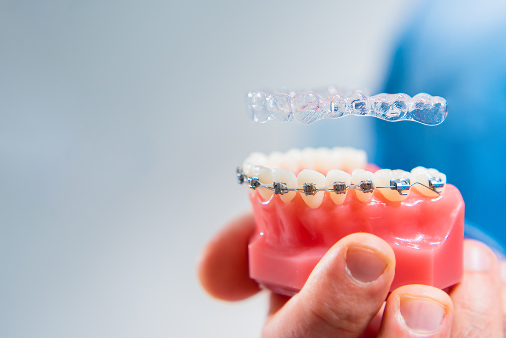 Braces vs Clear Aligners Comparison – Invisalign Irvine A dental model showing traditional braces and clear aligners for orthodontic options – Invisalign Irvine