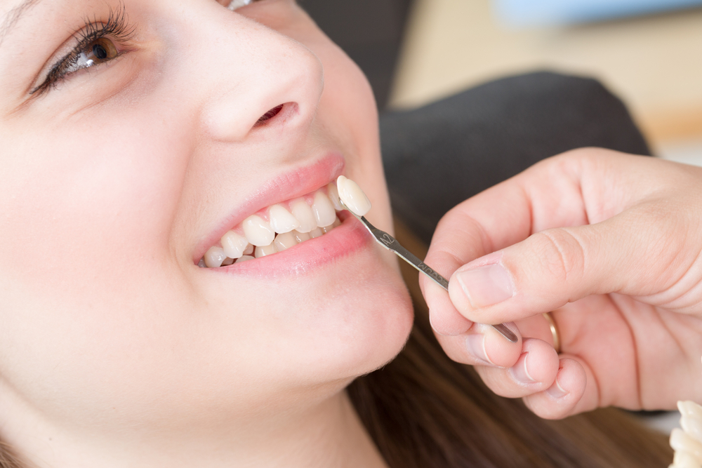 Dental Shade Matching for Veneer Treatment A close-up of a dentist comparing tooth shades to ensure natural-looking cosmetic results